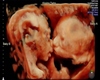 Kissing Twins Ultrasound