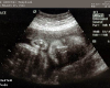 !DMS! MzD Ultrasound Pic