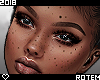 Freckles