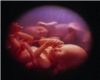 ~LF~ Twins ultrasound