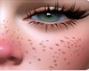 Freckles