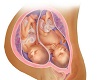 {ALC}9 Month Twins Fetus