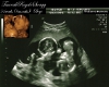 Tauv 6month ultrasound