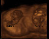 Bluetopaz's ultrasound