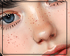 K| freckles