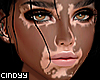 [ Fox Skin Vitiligo
