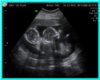 {Ash} twins ultrasound