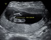 Missy's ultrasound pic