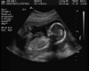 Girl Ultrasound