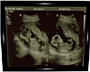 KUB|Our Twins Ultrasound