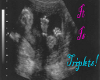 1M,2F,triplet ultrasound