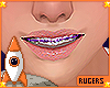 Kid/Teen Purple Braces