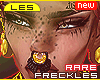 Rare Freckles & Moles