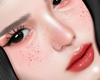 freckles