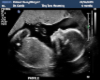Baby Hen3ssy Ultrasound