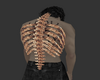 Scoliosis.