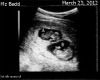 mzbadd 2 month ultrasoun