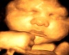 Cutes  ultrasound pic