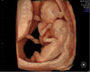 Twins HH Ultrasound HD