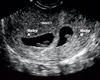 4 Weeks Twins Ultrasound