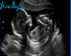 Male baby Ultrasound