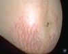 Belly Add Stretchmarks