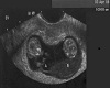newborn twins ultrasound
