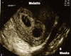 Custom 6 Week Ultrasound