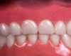 Derivable Teeth F