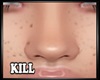 Freckles