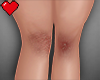 srn. Scraped Knees