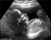 LaBelleScarfo ultrasound