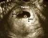 Early Twins HH Sonogram