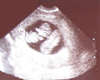 ultrasound of twins