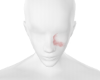 birthmark