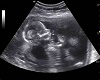 ultrasound w/steelers fr
