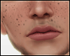 Freckles