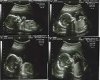  quadruplets ultrasound