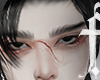 wound