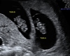 8 Week Twin Sonogram HH