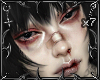 MH. bruises