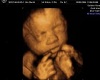 Maxwell ultrasound pic