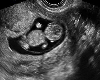 [AS]Ultrasound Photo <3