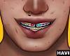 🦈Colorful Braces🦈