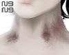neck bruises