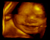 SDFU boy ultrasound