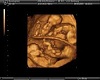 *cp* ultrasound twins 4m