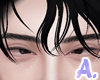 A. Crossed eyes