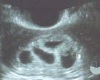 quad ultrasound pic