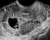 4 Weeks Ultrasound Pic